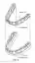 Fig. 02 - Segmented orthodontic appliance with elastics