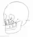 Fig. 01 - Orthognathic implant and methods of use