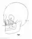 Fig. 02 - Orthognathic implant and methods of use
