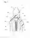 Fig. 02 - Implant overdenture system and implant