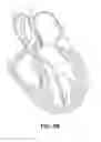 Fig. 06 - DEVICES AND METHODS FOR DELIVERING AN ENDOCARDIAL DEVICE