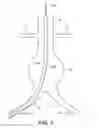 Fig. 02 - ENDOVASCULAR DELIVERY SYSTEM WITH FLEXIBLE AND TORQUEABLE HYPOTUBE