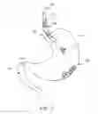 Fig. 06 - Magnetic device to control obesity and related method of use