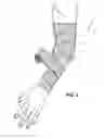 Fig. 03 - Limb Immobilization Wrap
