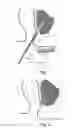 Fig. 02 - System for preventing bacterial infections in needle trajectories