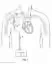 Fig. 02 - Devices, methods and systems for counterpulsation and blood flow conduit connection