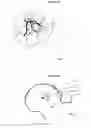 Fig. 10 - Method for determining bone resection on a deformed bone surface from few parameters