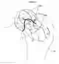 Fig. 12 - Method for determining bone resection on a deformed bone surface from few parameters