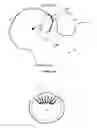 Fig. 20 - Method for determining bone resection on a deformed bone surface from few parameters