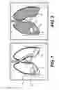Fig. 02 - DEVICES AND METHODS FOR MODIFYING A VOLUME OF A CAVITY