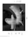 Fig. 09 - DENTAL DEVICE COMPRISING SURGICAL TEMPLATE AND FALSE TEETH SET AND RELATED METHODS
