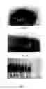 Fig. 02 - Method of inducing osteogensis and promoting osseointegration around an implant