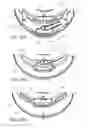 Fig. 41 - Ventricular cuff
