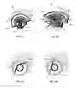 Fig. 22 - Vascular access port