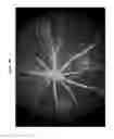 Fig. 05 - Compositions and methods for treatment of diabetic macular edema