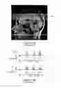 Fig. 04 - Pseudo-continuous asymmetric signal targeting alternating radio frequency (pASTAR) for magnetic resonance angiography
