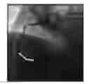 Fig. 01 - Detecting coronary stenosis through spatio-temporal tracking