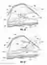 Fig. 06 - Multi-lumen-catheter retractor system for a minimally-invasive, operative gastrointestinal treatment