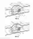 Fig. 32 - Multi-lumen-catheter retractor system for a minimally-invasive, operative gastrointestinal treatment