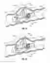 Fig. 33 - Multi-lumen-catheter retractor system for a minimally-invasive, operative gastrointestinal treatment