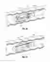 Fig. 35 - Multi-lumen-catheter retractor system for a minimally-invasive, operative gastrointestinal treatment