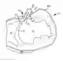 Fig. 01 - Trans-catheter ventricular reconstruction structures, methods, and systems for treatment of congestive heart failure and other conditions