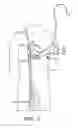 Fig. 05 - Trans-catheter ventricular reconstruction structures, methods, and systems for treatment of congestive heart failure and other conditions