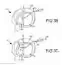 Fig. 07 - Trans-catheter ventricular reconstruction structures, methods, and systems for treatment of congestive heart failure and other conditions
