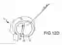Fig. 25 - Trans-catheter ventricular reconstruction structures, methods, and systems for treatment of congestive heart failure and other conditions