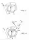 Fig. 31 - Trans-catheter ventricular reconstruction structures, methods, and systems for treatment of congestive heart failure and other conditions