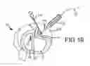 Fig. 32 - Trans-catheter ventricular reconstruction structures, methods, and systems for treatment of congestive heart failure and other conditions
