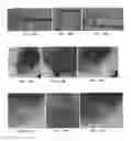 Fig. 40 - Trans-catheter ventricular reconstruction structures, methods, and systems for treatment of congestive heart failure and other conditions