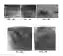 Fig. 41 - Trans-catheter ventricular reconstruction structures, methods, and systems for treatment of congestive heart failure and other conditions