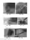 Fig. 42 - Trans-catheter ventricular reconstruction structures, methods, and systems for treatment of congestive heart failure and other conditions