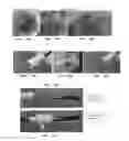 Fig. 43 - Trans-catheter ventricular reconstruction structures, methods, and systems for treatment of congestive heart failure and other conditions