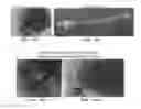 Fig. 44 - Trans-catheter ventricular reconstruction structures, methods, and systems for treatment of congestive heart failure and other conditions