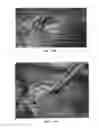 Fig. 49 - Trans-catheter ventricular reconstruction structures, methods, and systems for treatment of congestive heart failure and other conditions