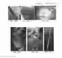 Fig. 50 - Trans-catheter ventricular reconstruction structures, methods, and systems for treatment of congestive heart failure and other conditions