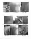 Fig. 51 - Trans-catheter ventricular reconstruction structures, methods, and systems for treatment of congestive heart failure and other conditions
