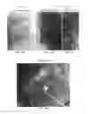 Fig. 52 - Trans-catheter ventricular reconstruction structures, methods, and systems for treatment of congestive heart failure and other conditions