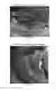 Fig. 53 - Trans-catheter ventricular reconstruction structures, methods, and systems for treatment of congestive heart failure and other conditions