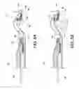 Fig. 06 - Surgical suturing device for a replacement anatomical structure and methods thereof