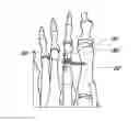 Fig. 01 - Method and device for correcting bone deformities