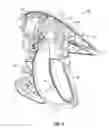 Fig. 04 - Surgical forceps capable of adjusting sealing pressure based on vessel size