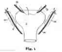 Fig. 02 - Methods and systems for treatment of prolapse