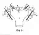Fig. 04 - Methods and systems for treatment of prolapse