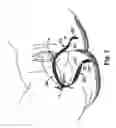 Fig. 09 - Methods and systems for treatment of prolapse