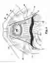 Fig. 11 - Methods and systems for treatment of prolapse