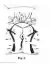 Fig. 12 - Methods and systems for treatment of prolapse