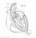 Fig. 06 - Retaining mechanisms for prosthetic heart valves